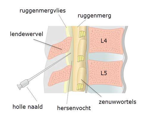 Diagram: mechanismen van vloeistofverlies en drukverlaging na lumbaalpunctie