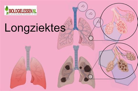 Illustratie van hoe asbestvezels in de longen terechtkomen.