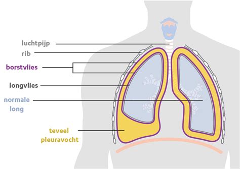 schematische weergave van de ontwikkeling van asbestkanker in de longen