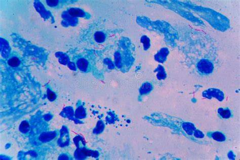 Micrografiek van Mycobacterium tuberculosis onder microscoop