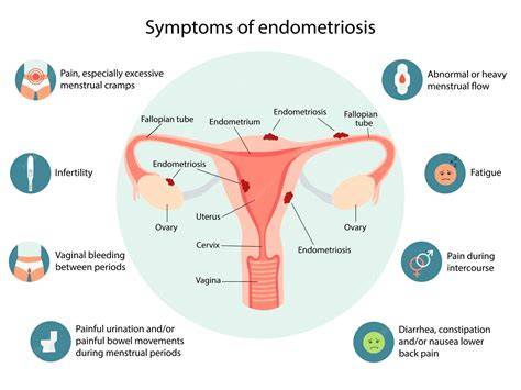 Infographic over endometriose en darmbetrokkenheid