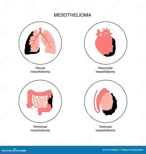 Diagram dat de ontwikkeling van mesothelioom toont