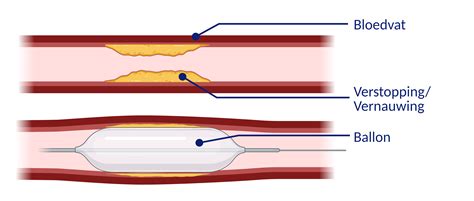 Infographic van interventieradiologie en dotteren
