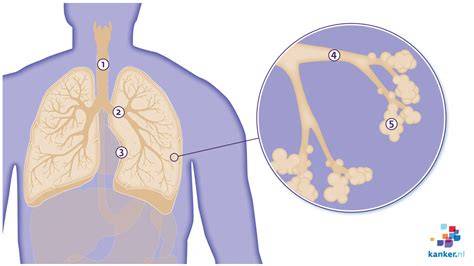 Infographic: route van asbest tot mesothelioom en latentietijd
