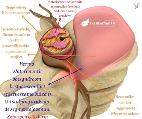 Infographic: Hoe werkt een tussenwervelschijf en waar kunnen zenuwen bekneld raken