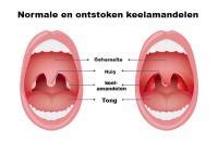 Illustratie van een rode, geïrriteerde keel met gezwollen amandelen.