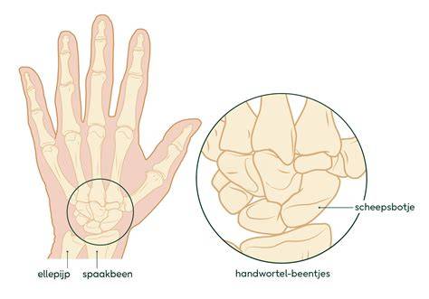 Pols met gips en slingillustratie