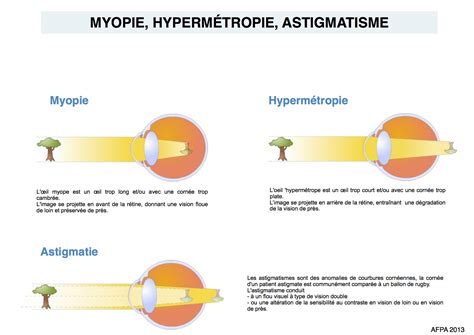 Infographic: Verhouding tussen dioptrieën, myopie en hypermetropie