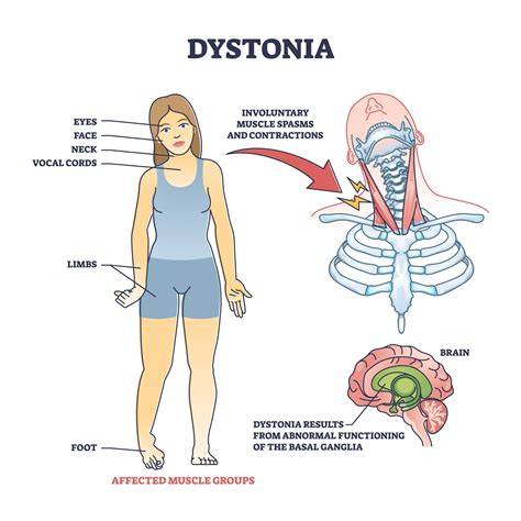 Infographic: Anatomie van cervicale dystonie en belangrijkste behandelopties