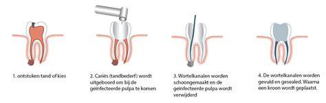 Infographic: stappen van vullingprocedure (verdoving, boren, droogleggen, lijmen, vulling aanbrengen, uitharden, afwerken)