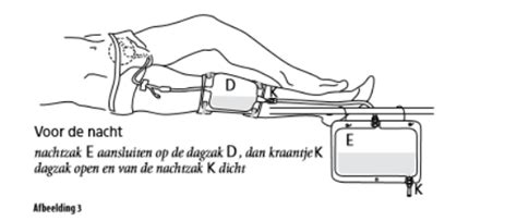 Illustratie van een gespecialiseerde anti-lekkage katheter