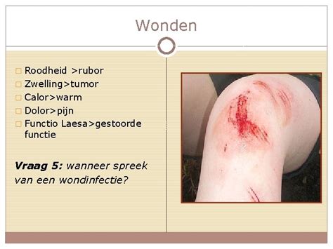 diagram: tekenen van een geïnfecteerde wond (roodheid, zwelling, pus)