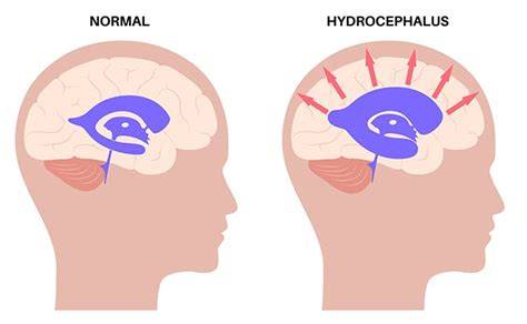 Infographic over Normal Pressure Hydrocephalus en triade symptomen