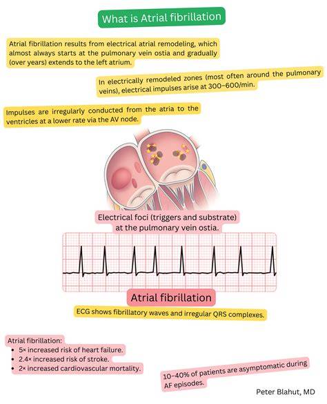 Infographic: Structure-Function Relationship of Atrial Fibrillation Waves