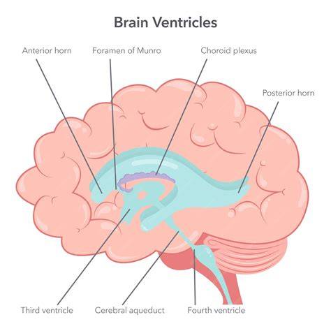 Diagram: Vergrote ventrikels na hersenletsel