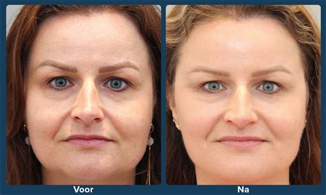 Voor- en na afbeelding van geïndustrialiseerde radiatorlak