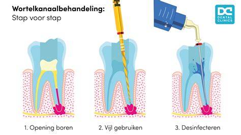 Infographic: Wortelkanaalbehandeling stap-voor-stap
