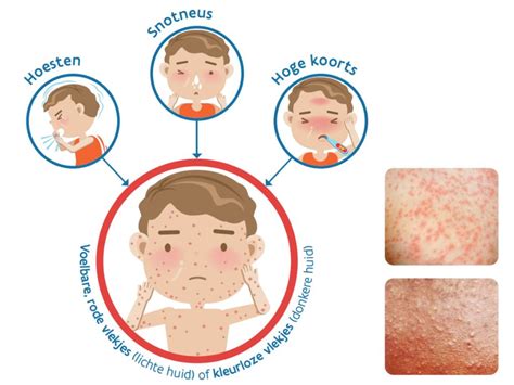 Illustratie die de symptomen van hemolacrie en mogelijke oorzaken toont.