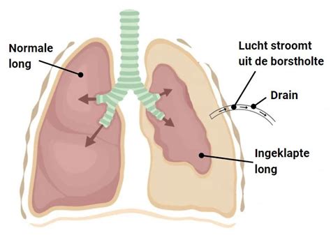 infographic_drainsysteem_en_zelfzorghandleiding