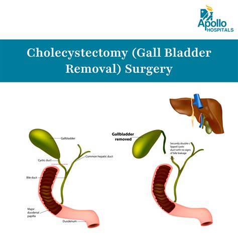 Infographic: Wat gebeurt er tijdens een cholecystectomie en recovery planning