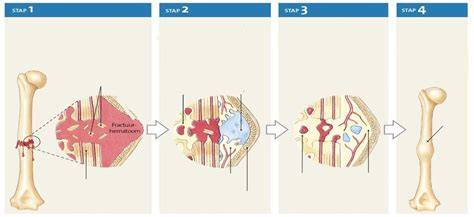 Diagram: galwegenletsel stappen bij herstel en reconstructie