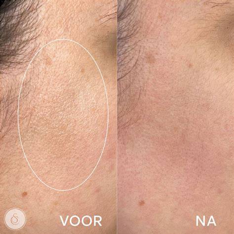 Diagram: open poriën before/after impregneren voor hechting