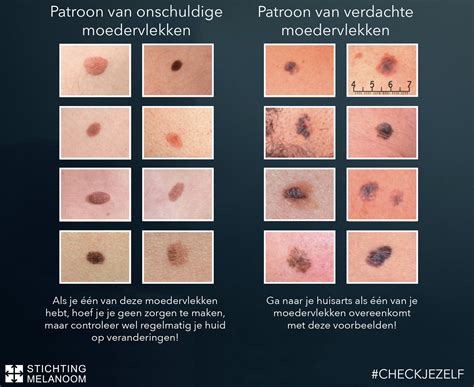 Table: Veelvoorkomende vlekken en bijbehorende oplossingen