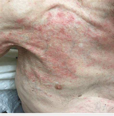 Infographic: overzicht van Radiation Recall Dermatitis: oorzaken, tijdlijn en behandeling